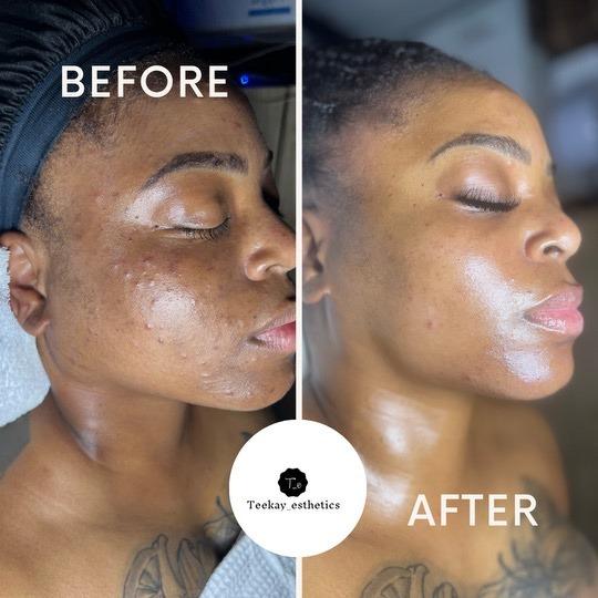 Before and after of a corrective facial treatment